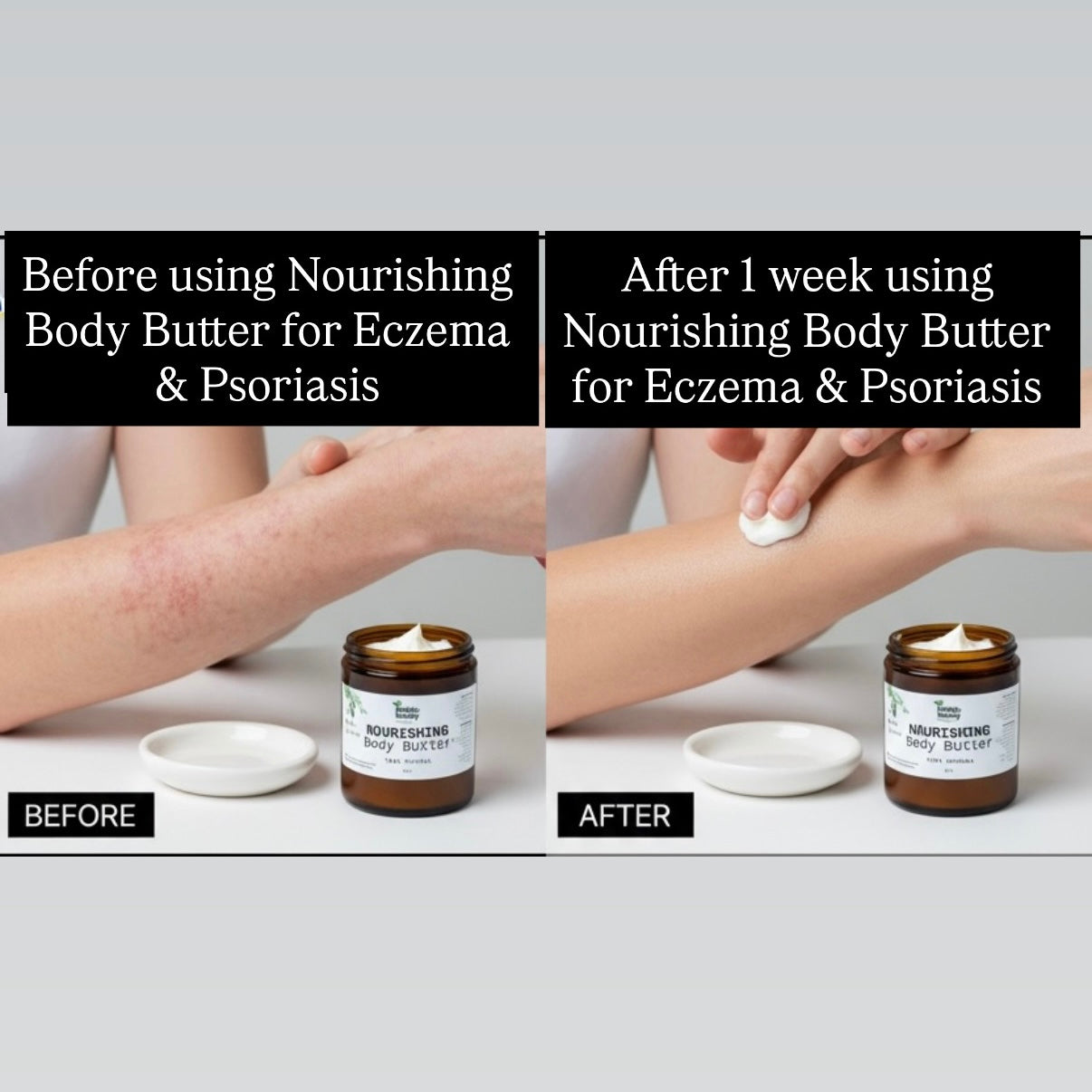 Nourishing Body Butter | Eczema & Psoriasis Relief
