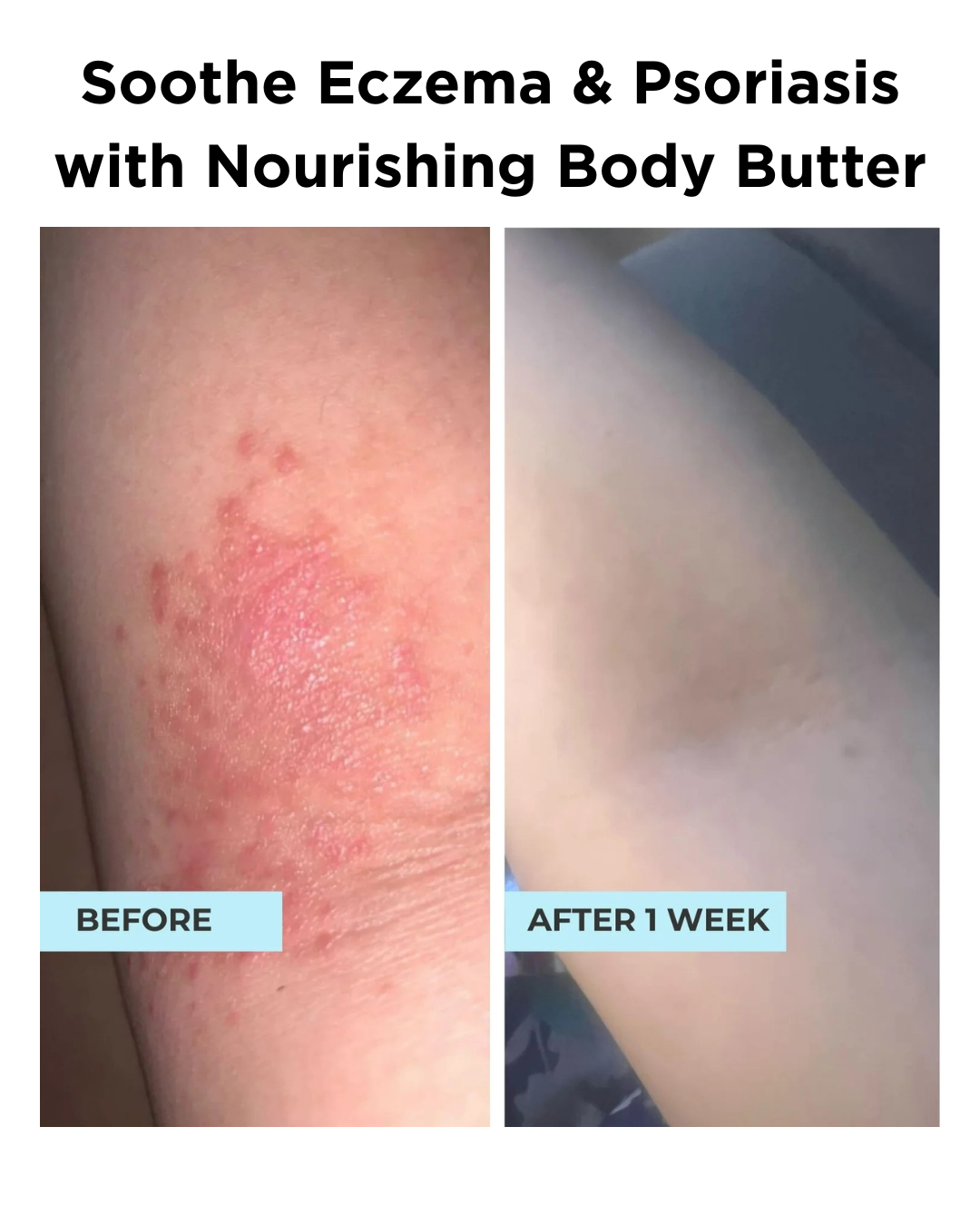Nourishing Body Butter | Eczema & Psoriasis Relief